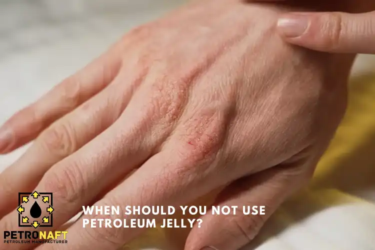 hands of women who do not use petroleum jelly